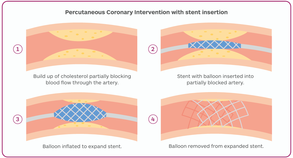 PCI image For Patients